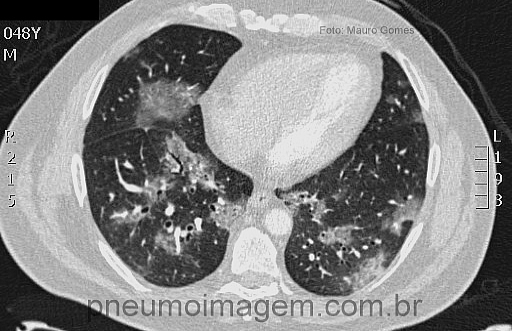 METAPNEUMOVÍRUS PODE SER IMPORTANTE PATÓGENO CAUSADOR DE INFECÇÕES RESPIRATÓRIAS METAPNEUMOVÍRUS PODE SER IMPORTANTE PATÓGENO CAUSADOR DE INFECÇÕES RESPIRATÓRIAS